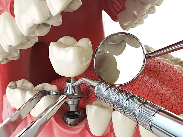 Best Chipped Tooth Repair Near Me  in Alpharetta, GA